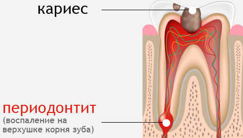 chto-takoe-periodontit