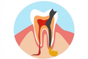 periodontit-zuba-lechenie-2
